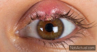 Qué es un orzuelo o pispelo y cómo se trata realmente