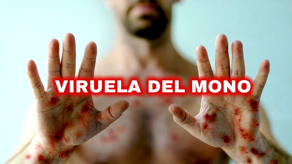 PERIODO DE INCUBACIÓN DE LA VIRUELA DEL MONO